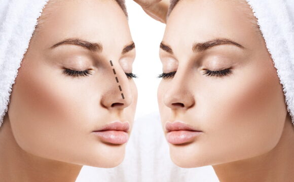 Rhinoplasty